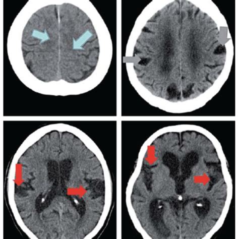 Ct Scan Images Taken From The Same Nph Patient At Different Angles The