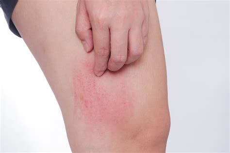 The redness may be harder to see on. hives | Health Beat