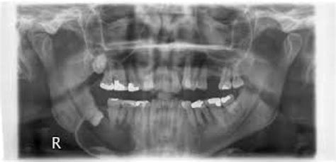 Cyst Wisdom Teeth Removal Hiring The Professionals For Safe Removal