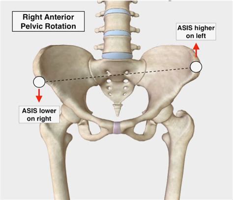A Twisted Pelvis Also Called Pelvic Torsion Can Be Corrected