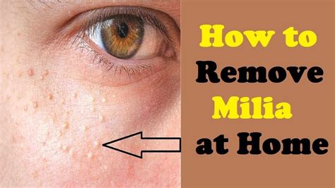 How To Remove Milia At Home Howotremvo