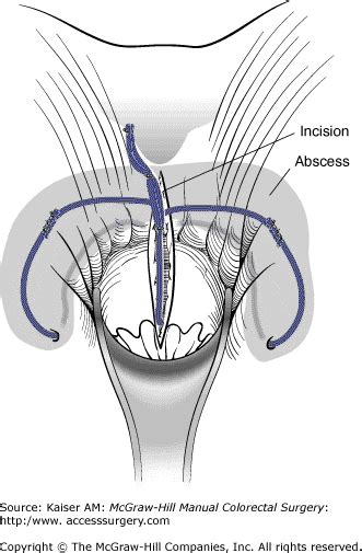 It forms part of the broader group of anorectal abscesses. Incision And Drainage Of Superficial Perineal Abscess Cpt ...