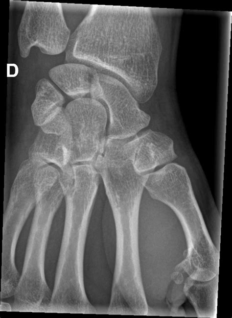 Dorsal Triquetral Avulsion Fracture Image