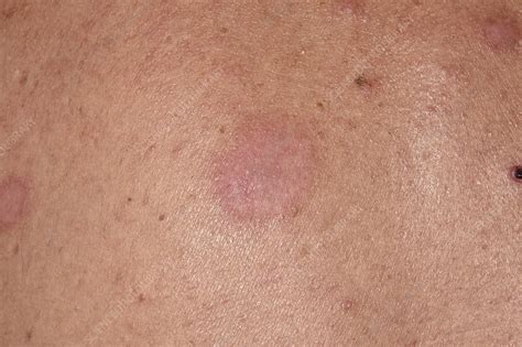 Discoid Eczema Stock Image C0498269 Science Photo Library
