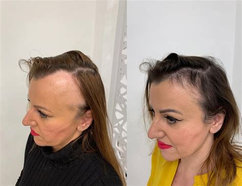 Hair Loss In Women Female Hair Loss Treatment Birmingham