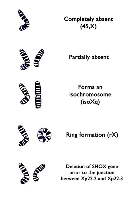 Fileturner Syndrome X Chromosome Variations Embryology