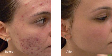 Acne Laser Treatment Los Angeles Blue Light Acne Removal