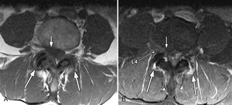 Synovial Cyst Radiology Key