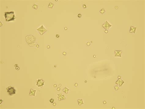 Alkalization of the urine and its effects on the ionization and excretion of calcium in the urine of patients with oxalate stones (clinical report). Microscopic Analysis of Urine | Faculty of Medicine ...