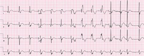 A Patient With Rbbb And Left Anterior Fascicular Block There Is Mild