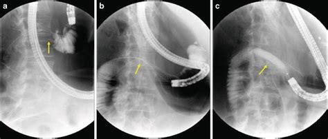Small Bowel Strictures Dilation And Stent Placement Abdominal Key