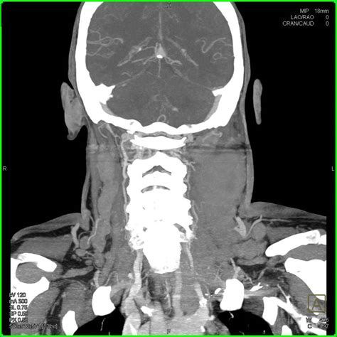 Learn more about types of nhl and. Lymphoma with Massive Neck Adenopathy - Neuro Case Studies ...
