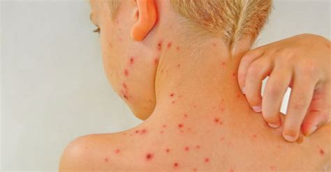 Skin Rashes In Children Pictures Health And Wellness Blog