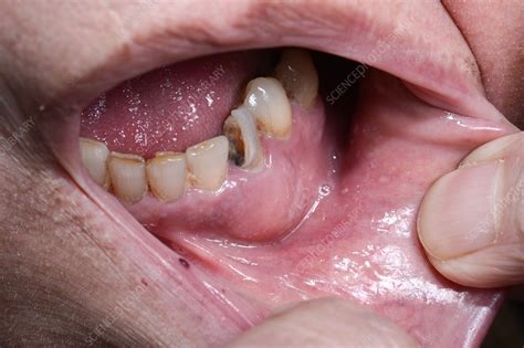 Dental Abscess In The Mouth Stock Image C0156143 Science Photo