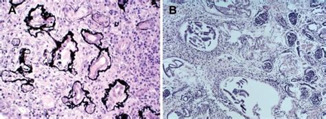 Nephronophthisis And Renal Cystic Dysplasia A Pathohistology Of