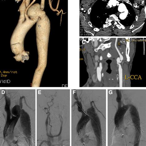 Cta Demonstrated An Aortic Arch With 50 Mm Sized Saccular Aneurysm At