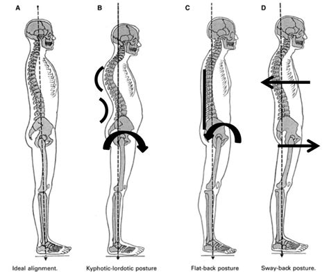 One Ideal Spinal Posture Does Not Exist Atlas Of Science