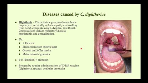Corynebacterium Diphtheriae Diphtheria Microbiology Boot Camp Youtube