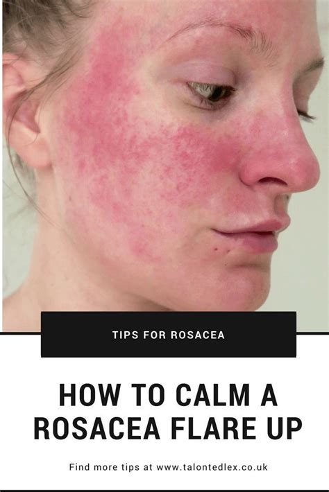 How To Calm Rosacea Flare Ups Tips And Tricks Talonted Lex