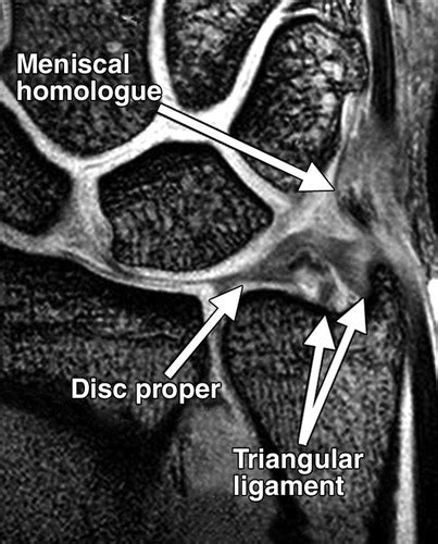 Ulnar Collateral Ligament Wrist Mri