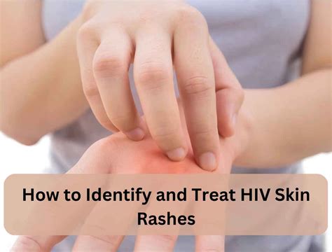 How To Identify And Treat Hiv Skin Rashes