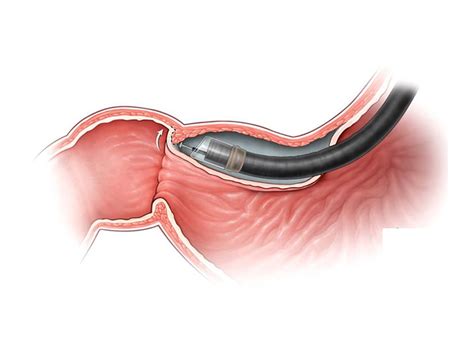 Gastric Peroral Endoscopy Myotomy G Poem Procedure Dallas Tx