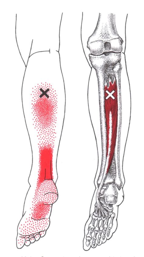 Hinterer Schienbeinmuskel The Trigger Point Referred Pain Guide