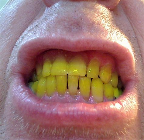 My Yellow Teeth Free Stock Photo Public Domain Pictures