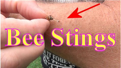 How To Get Rid Of Bee Stings Crazyscreen21