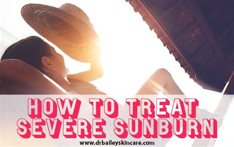 How To Treat Severe Sunburn Doctors Quick And Long Term Treatment Tips