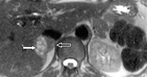 Chemical Shift Mr Imaging Of The Adrenal Gland Principles Pitfalls