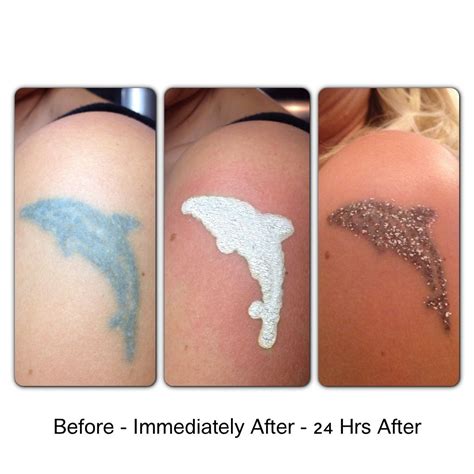 Exposing your skin to the water in a bathtub, swimming pool or hot tub puts you at risk for an infection and will significantly slow the recovery process. Non laser tattoo removal Precision Cosmetic Clinics ...