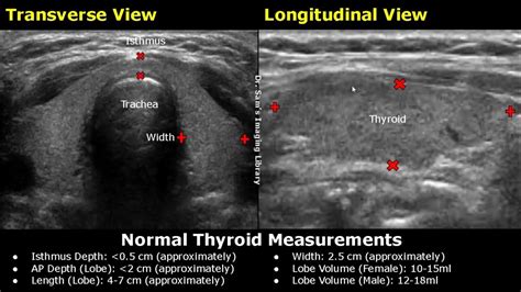 How To Measure Thyroid On Ultrasound Length Width Ap Depth And Volume