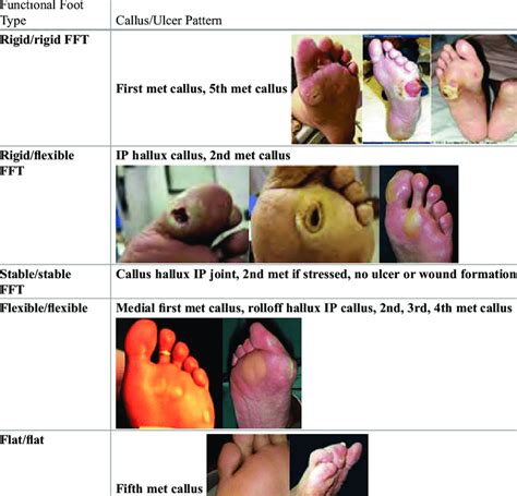 Ulcer Locations Of The Common Foot Types Download Table