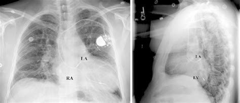  cxr can distinguish the pacer from icd (see icd section): An AP and lateral view of a CXR showing a dual chamber ...