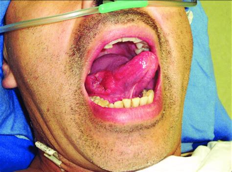 Decimal Trasplante Estribillo Carcinoma Epidermoide En Cavidad Oral