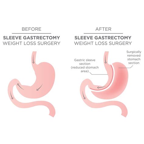 Sleeve Gastrectomy For Weight Loss Bariatric Clinic Singapore By G