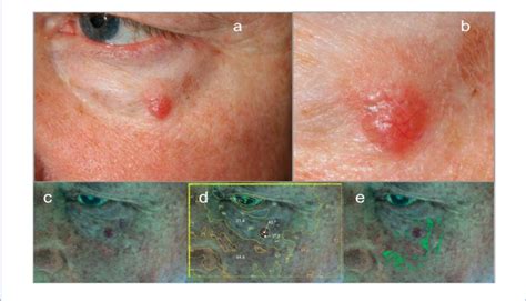 Skin Basal Cell Carcinoma In The Left Periorbital Region Download