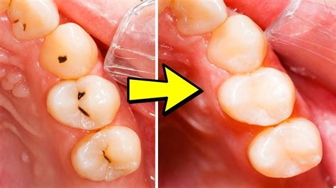 How To Heal Tooth Decay And Reverse Cavities By This Remedy Youtube