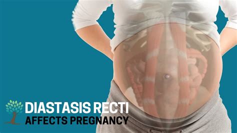 How Diastasis Recti Affects Pregnancy Diastasis Ed 5 Youtube
