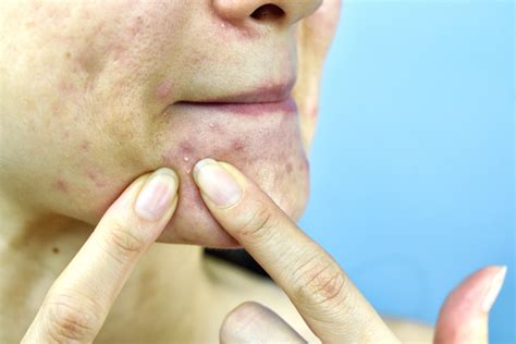 Comedonal Acne Causes Treatments Extraction And More