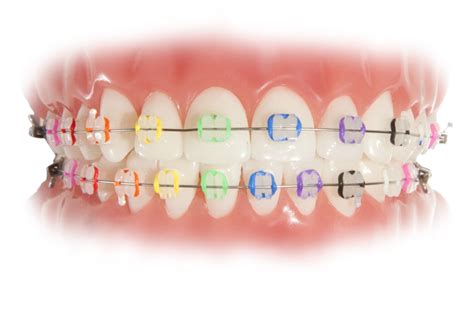 There are many options available for braces colors. Clear Braces | Clear Braces Huntington Beach | Surf City ...