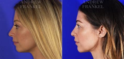 Jawline Contouring Before And After Photos Andrew S Frankel Md