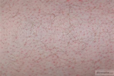 Small Red Bumps On Legs During Pregnancy Pictures