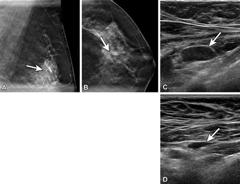 Axillary Lymphadenopathy In The Covid 19 Era What The Radiologist