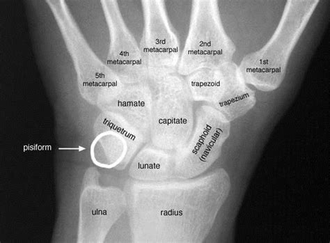 Hook Of Hamate Fracture Hand