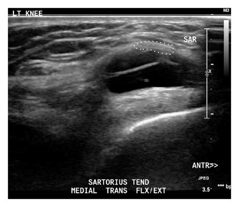 A Series Of Dynamic Ultrasound Images Taken In Knee Flexionextension