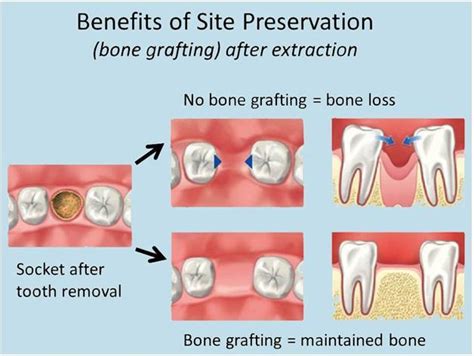 Bone Grafting After Tooth Extraction By Your Dentist In Fort Lauderdale