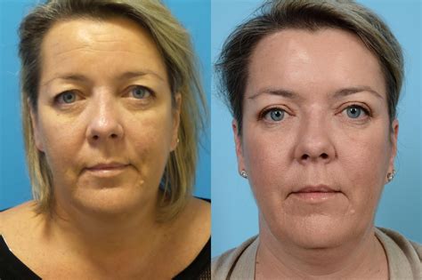 Eyelid Surgery Before And After Photos Patient 441 Chicago