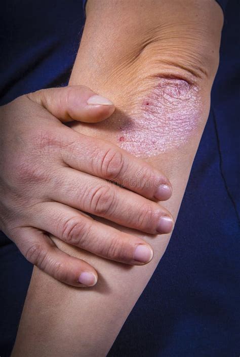 Psoriasis On Elbow Stock Photo Image Of Close Disorder 41100300